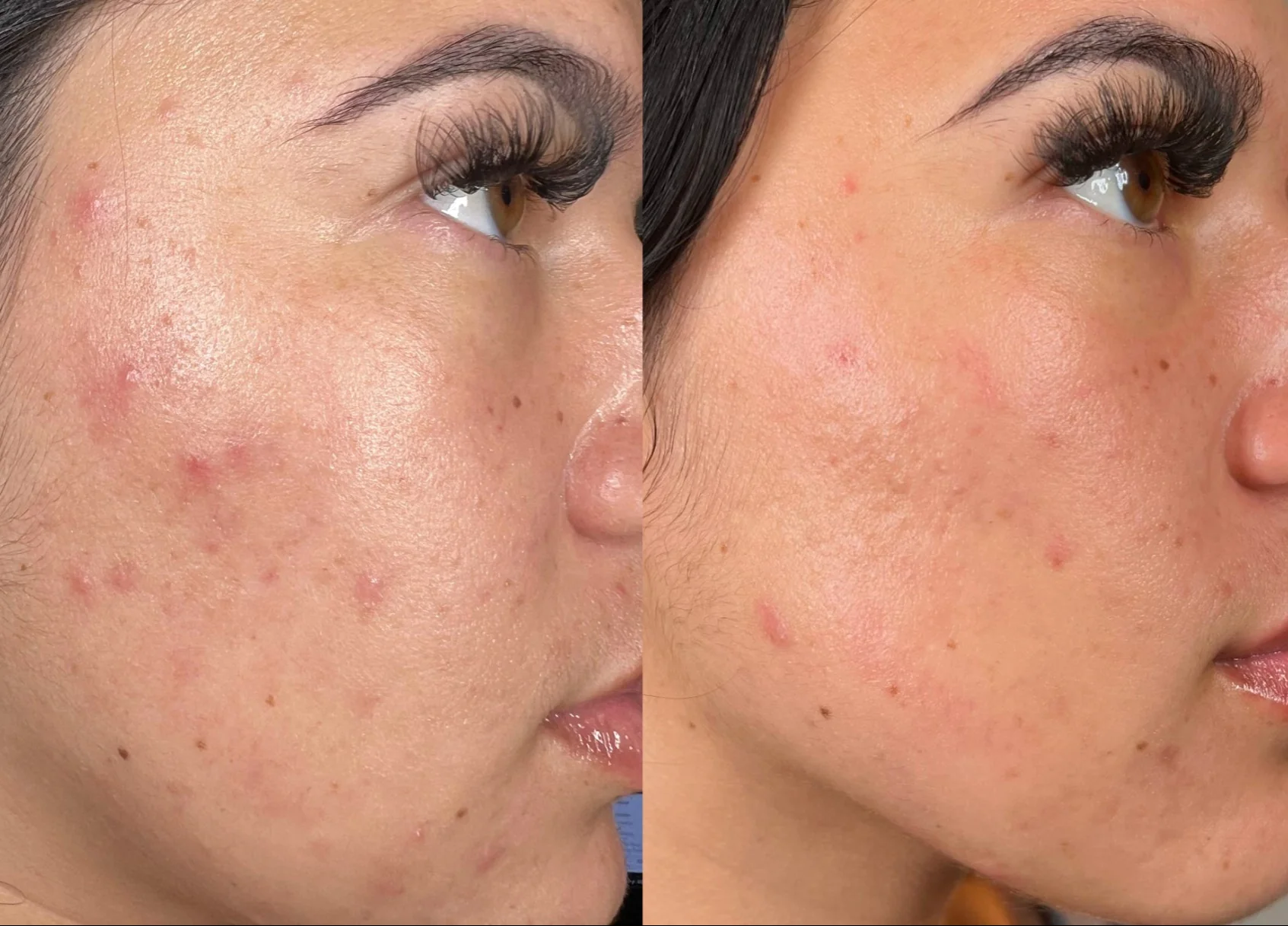 Acne Treatment Result