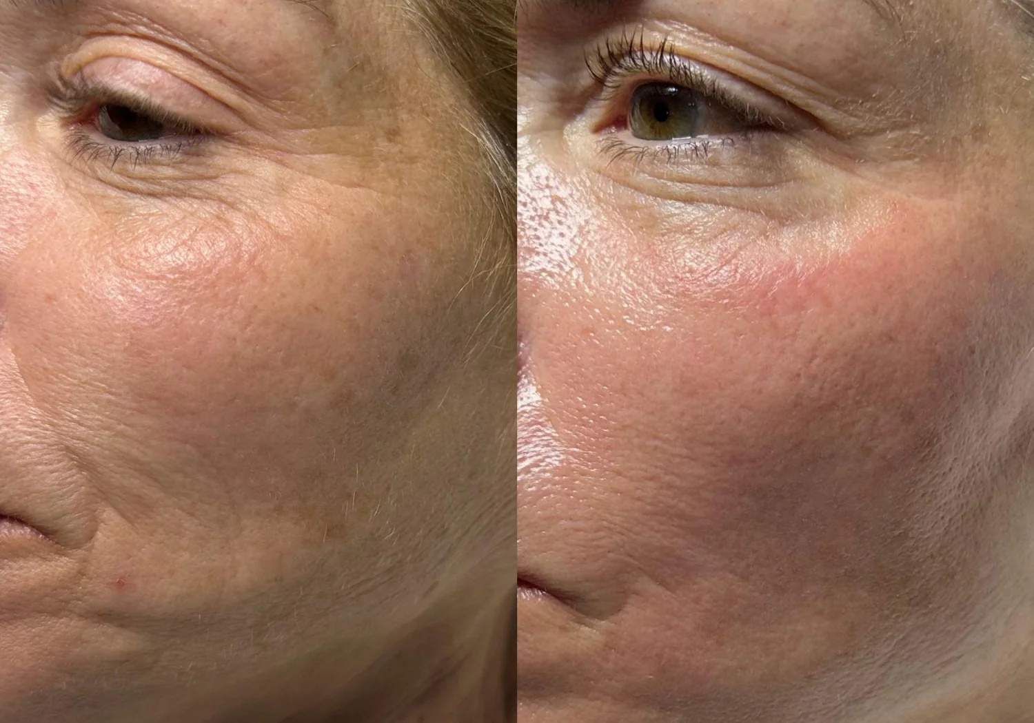 Fine Lines & Wrinkles Result