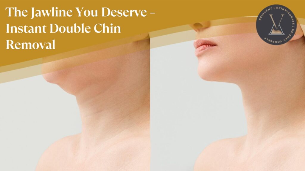 Get the Jawline You Deserve – Instant Double Chin Removal with CoolSculpting & RF!