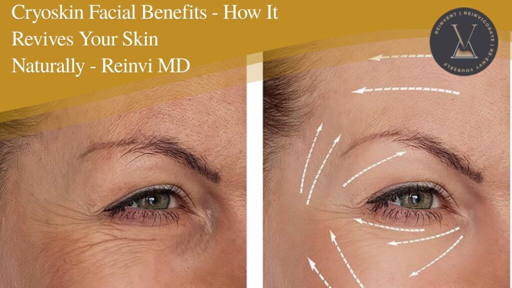 Cryoskin Facial Benefits