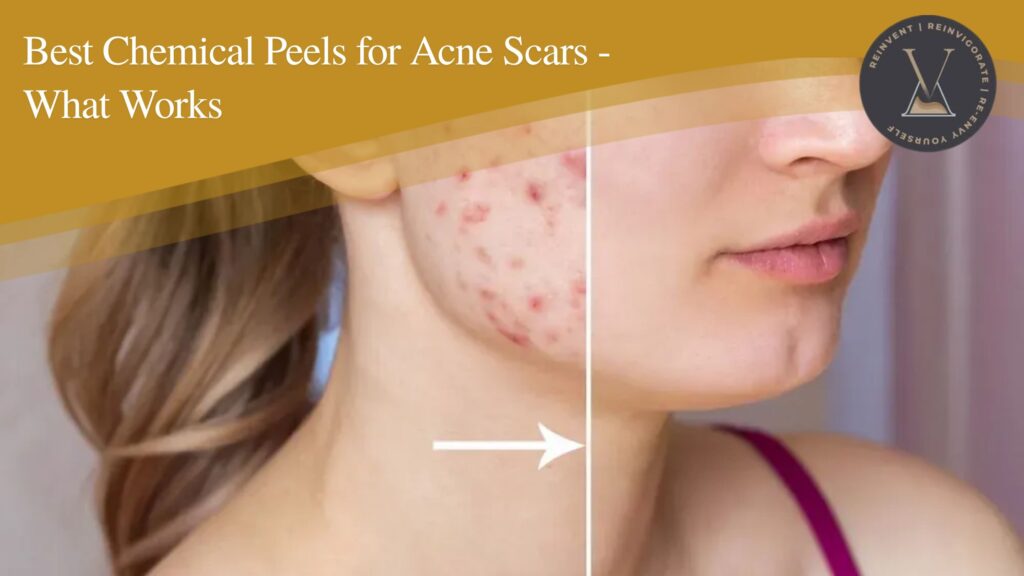 Chemical peels for acne scars