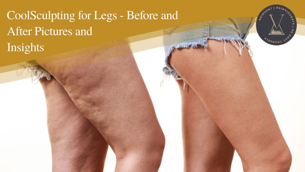 CoolSculpting for Legs Before and After