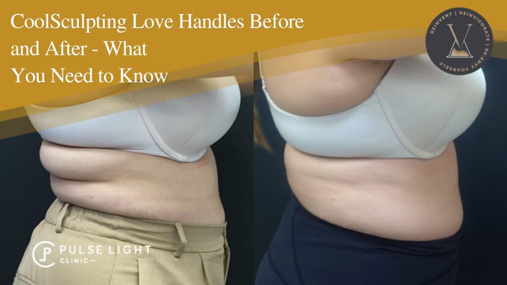 CoolSculpting Love Handles Before and After