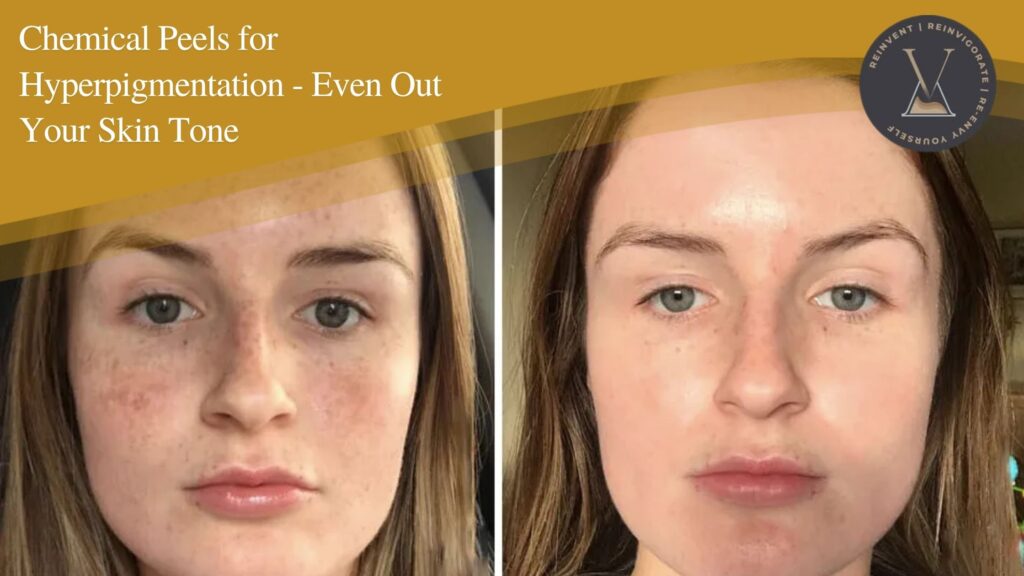 Chemical Peels for Hyperpigmentation