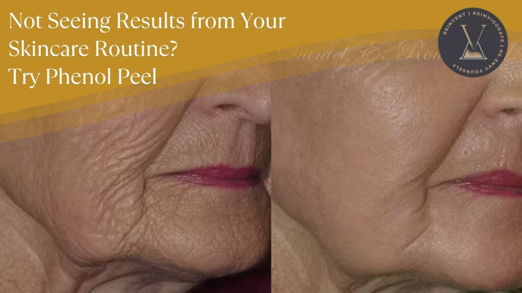 Not Seeing Results from Your Skincare Routine Try Tapping into Phenol Peel Benefits