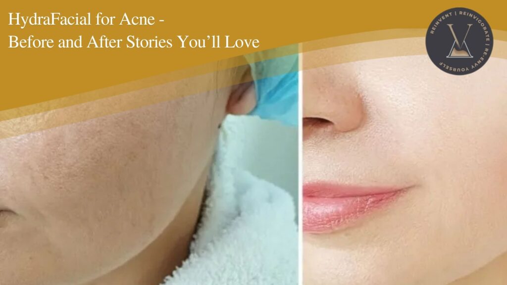 HydraFacial for Acne