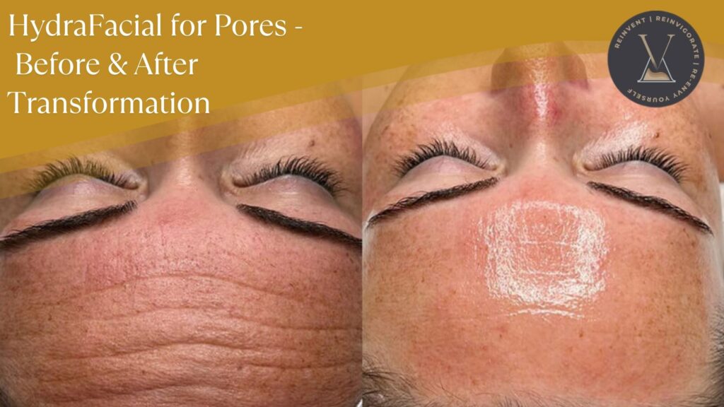 HydraFacial for Pores - Before and After Transformations
