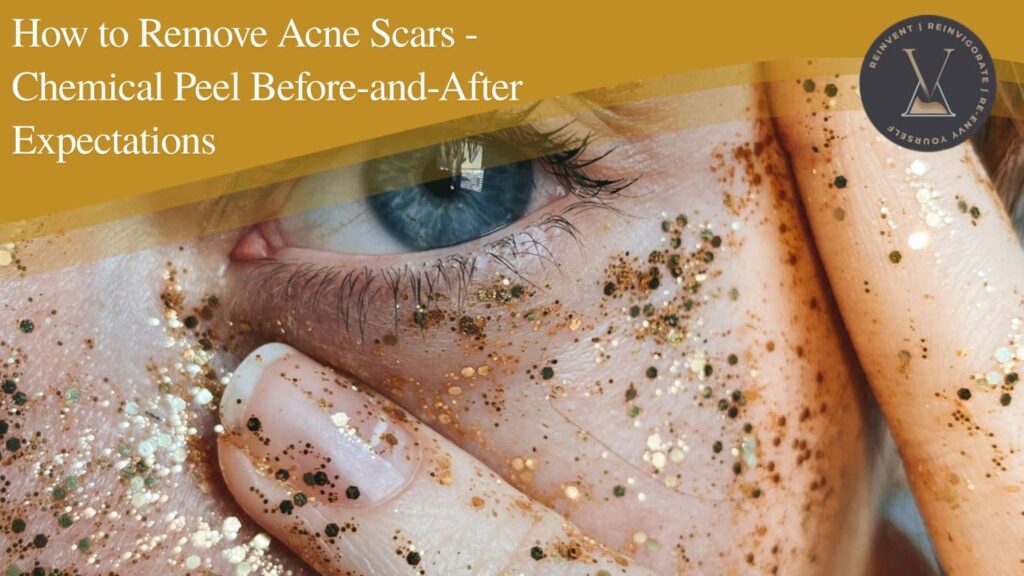 How to Remove Acne Scars