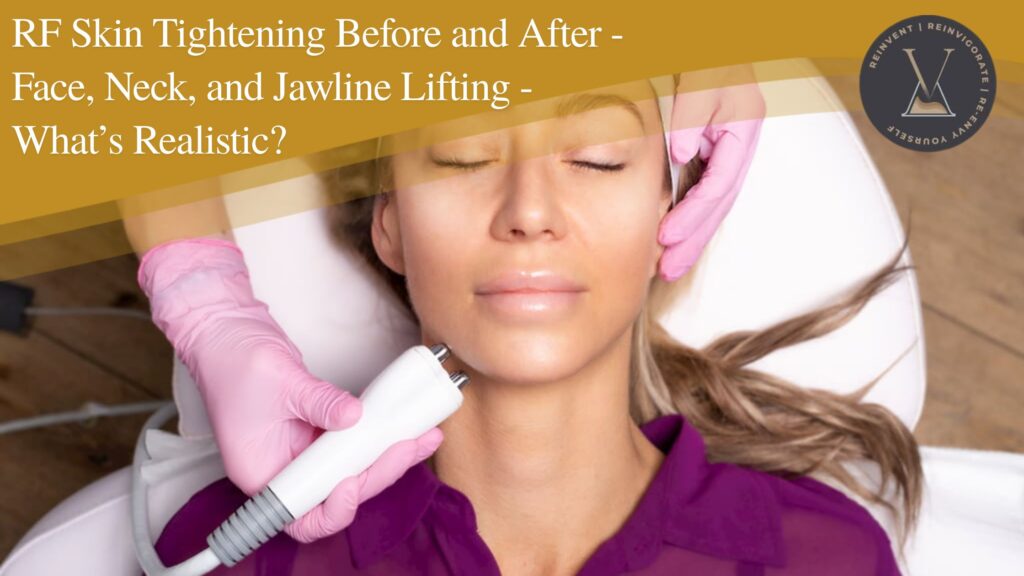 RF Skin Tightening Before and After